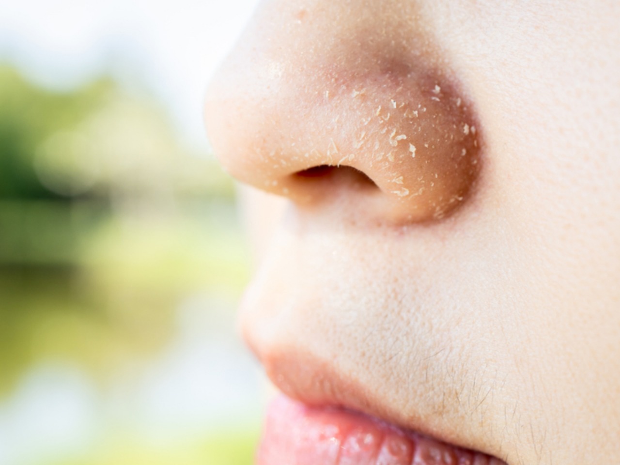 Rawat Kulit Kering Pada Hidung Secara Semulajadi
